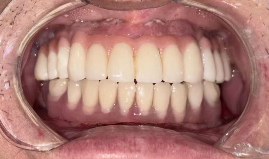 尉金平戴牙后口腔内照片