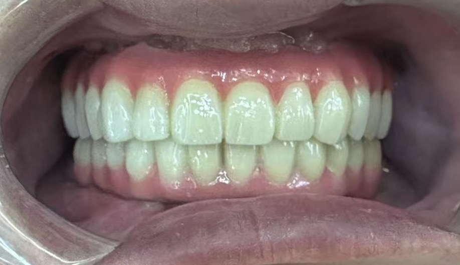 王军戴牙后口腔内照片