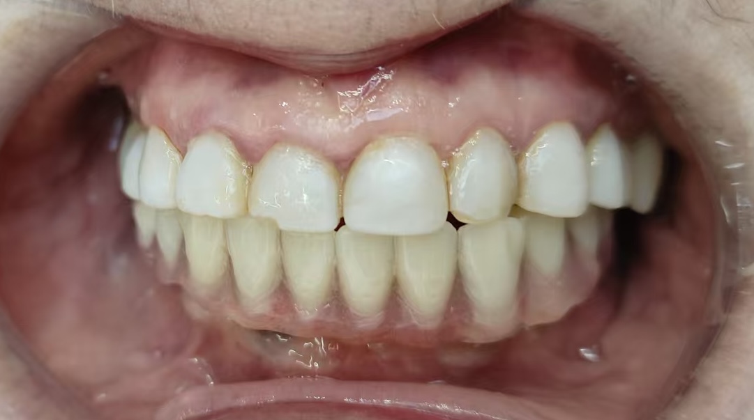 张晓丽戴牙后口腔内照片